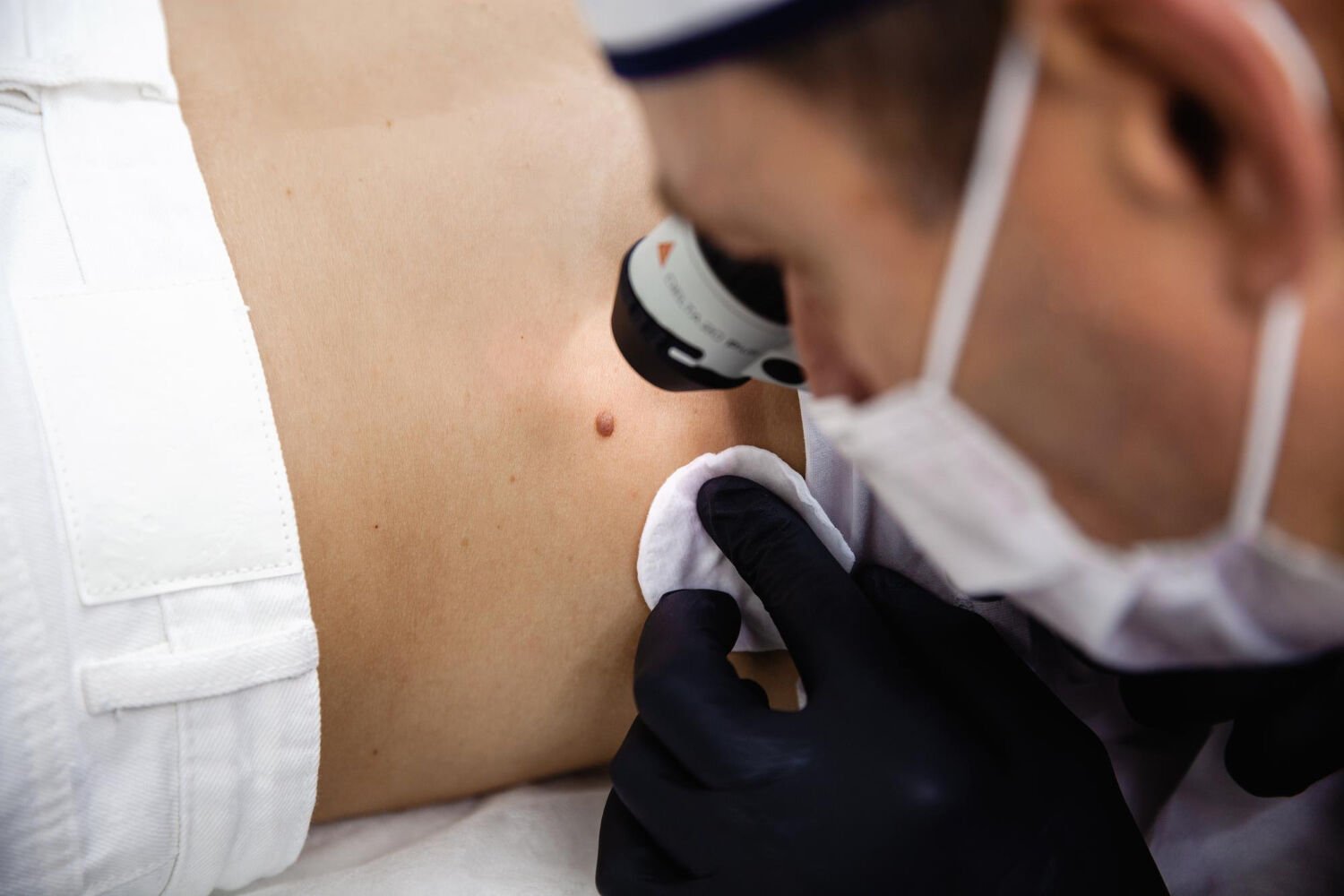 A dermatologist in a white cap and black gloves examines a mole on the patient's back using a dermatoscope during a mole check in Bangkok