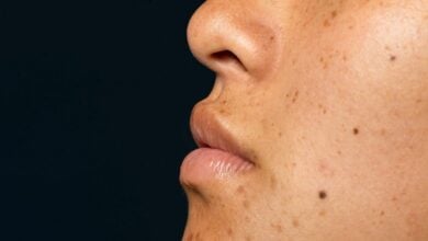 Should you get your moles checked by a dermatologist regularly?