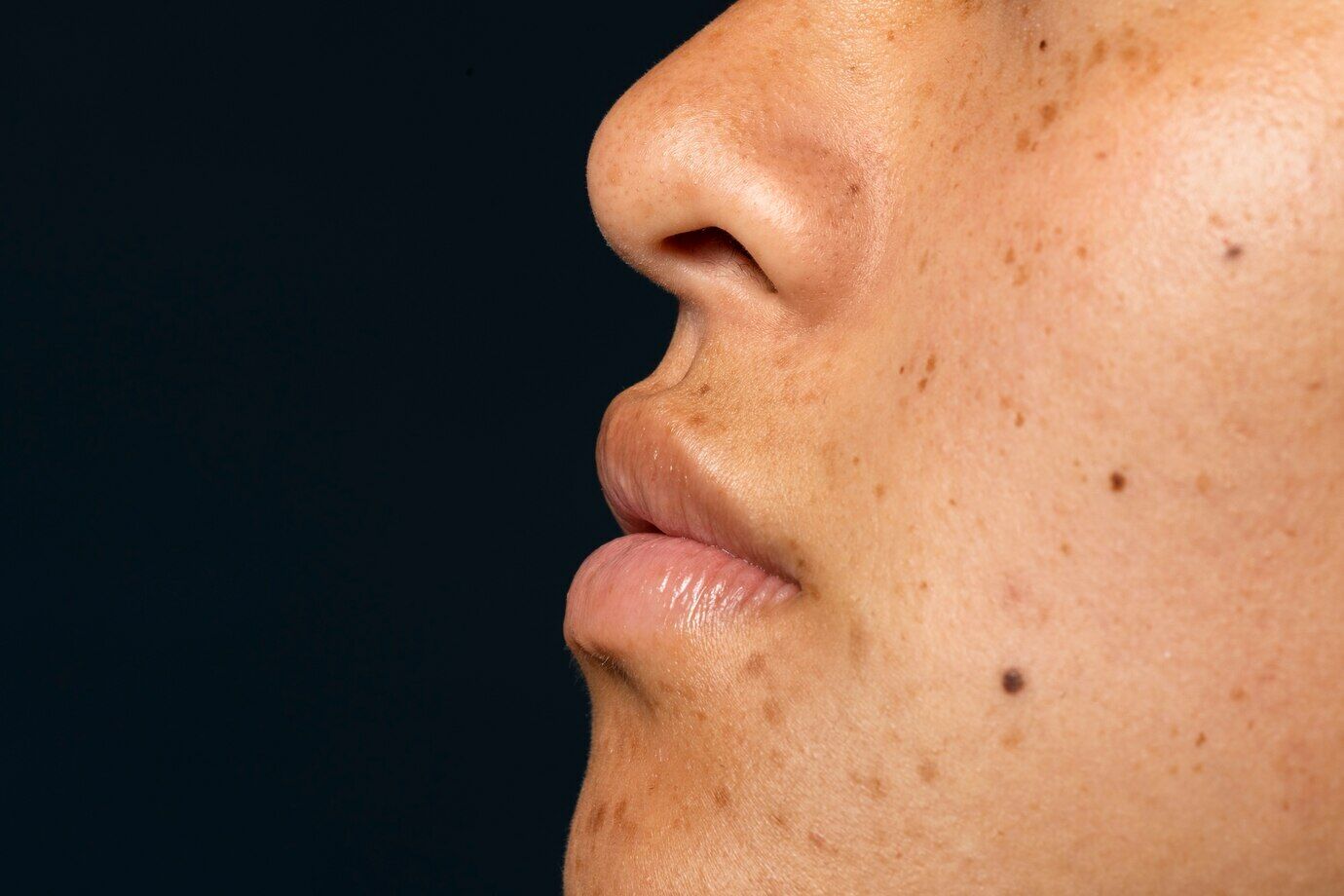 Should you get your moles checked by a dermatologist regularly?