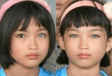 Laotian mother appeals for hearing aids for blue-eyed twins with rare condition