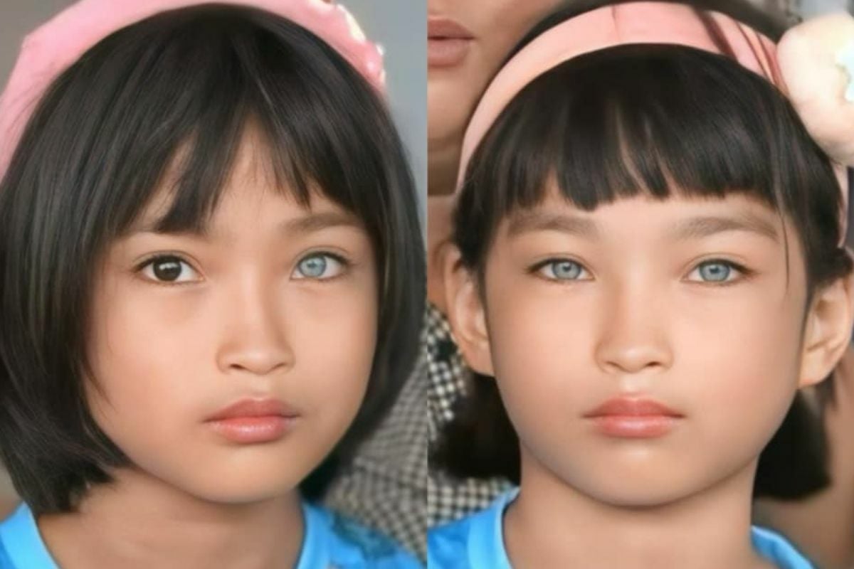 Laotian mother appeals for hearing aids for blue-eyed twins with rare condition