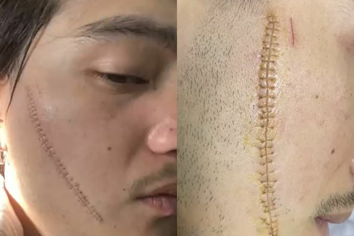 Thai man cut on face with knife in dispute with Bangkok taxi driver