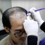How Hairtran Clinic in Bangkok delivers hair transplants that actually look good