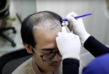 How Hairtran Clinic in Bangkok delivers hair transplants that actually look good