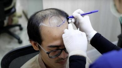 How Hairtran Clinic in Bangkok delivers hair transplants that actually look good