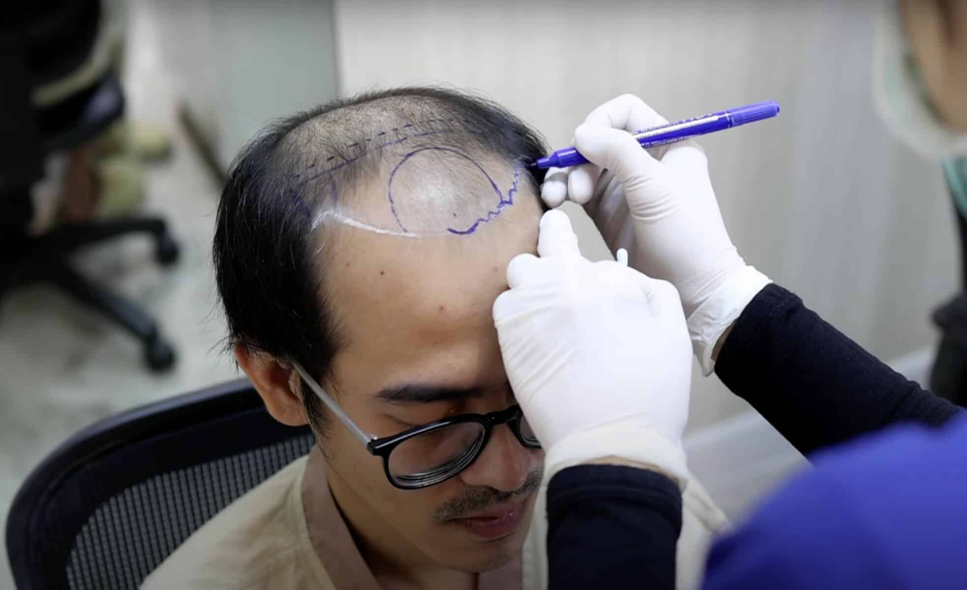 How Hairtran Clinic in Bangkok delivers hair transplants that actually look good