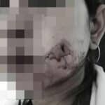 Bangkok woman suffers excessive blood loss after dimple surgery | Thaiger