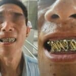 Broken jaw blunder: Botched surgery leaves Thai man unable to eat | Thaiger
