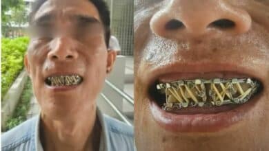 Broken jaw blunder: Botched surgery leaves Thai man unable to eat