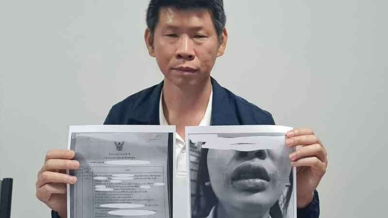 Bite club: German man sinks teeth into Korat dentist, sparks panic | News by Thaiger