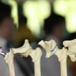 Thailand pioneers 3D-printed titanium hip socket surgery