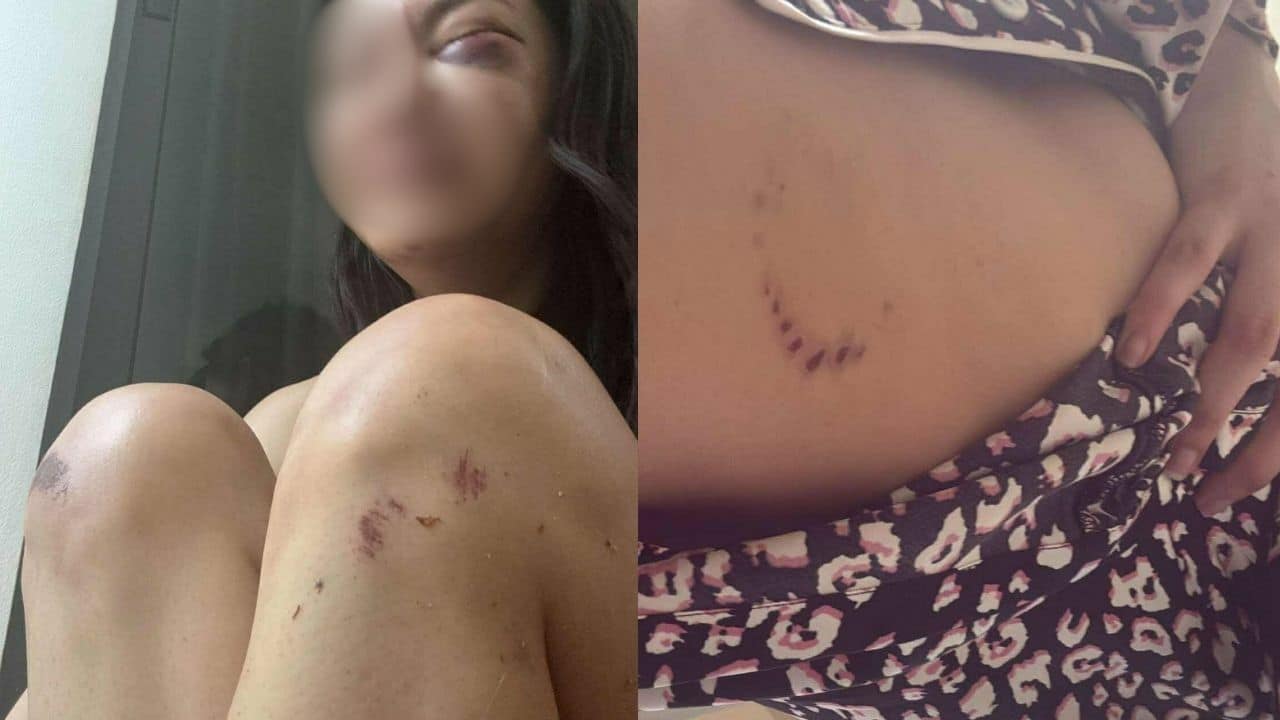 Thai woman suffers physical abuses by ex-boyfriend