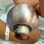 Thai teenage girl’s finger freed after 9 hours stuck in doorknob