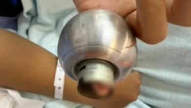 Thai teenage girl’s finger freed after 9 hours stuck in doorknob
