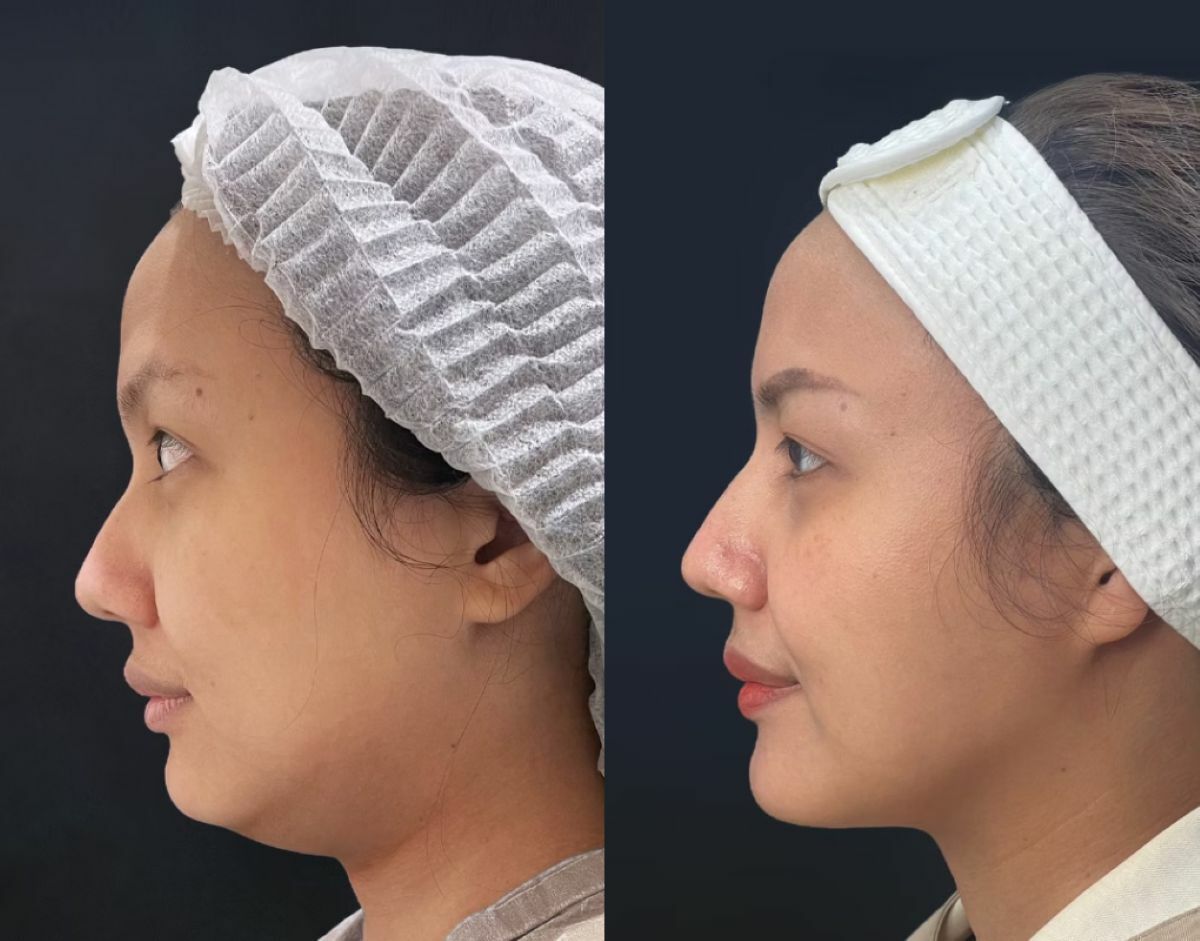 Your guide to the best place for liposuction in Bangkok | News by Thaiger