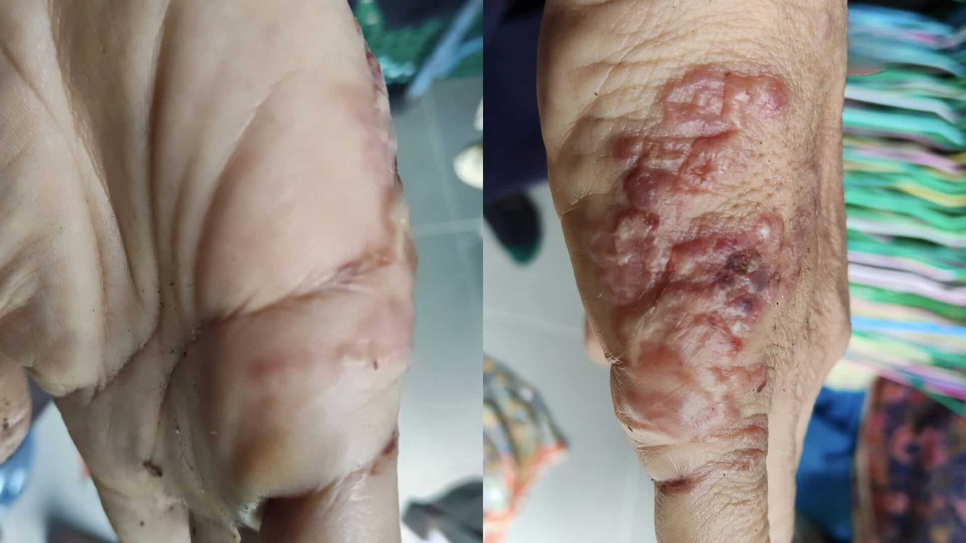 Thai man’s mysterious skin blisters revealed as 'skin worms' | News by Thaiger