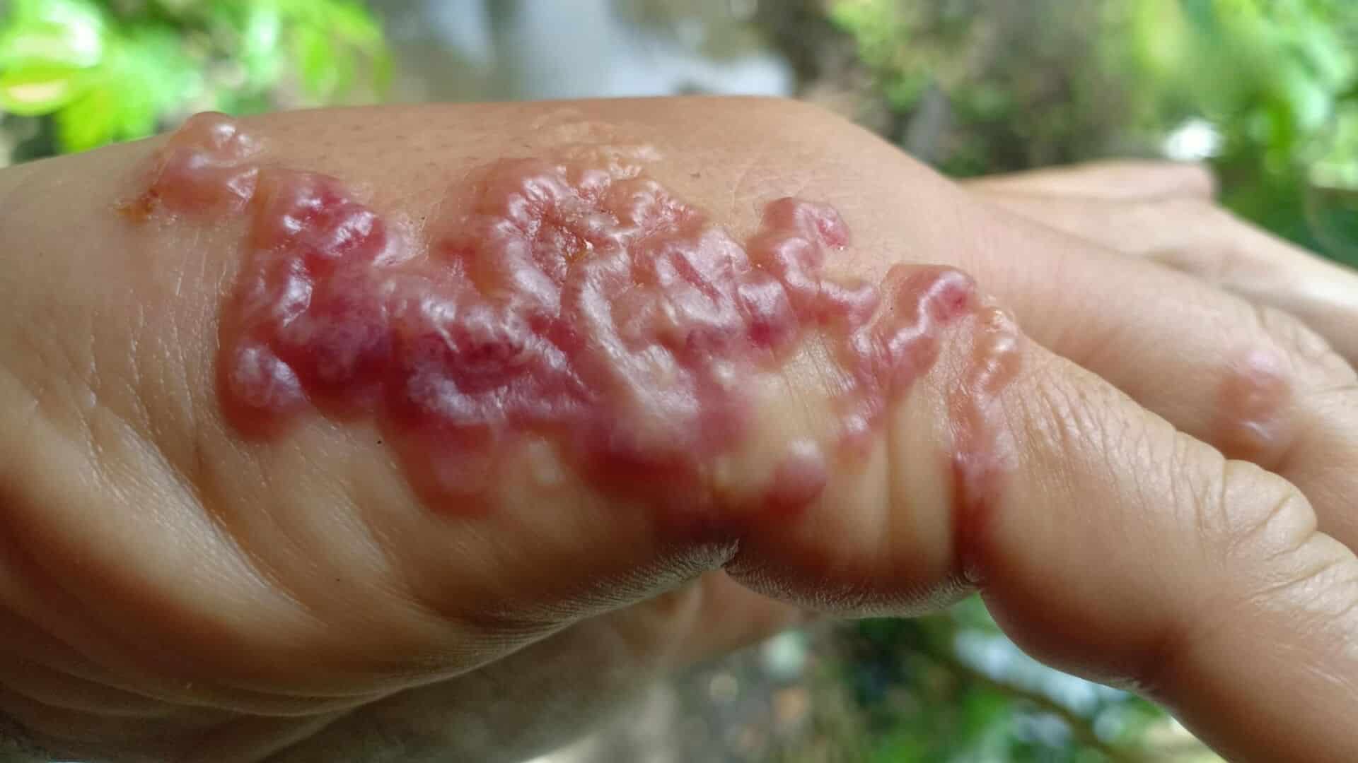 Thai man’s mysterious skin blisters revealed as 'skin worms' | News by Thaiger