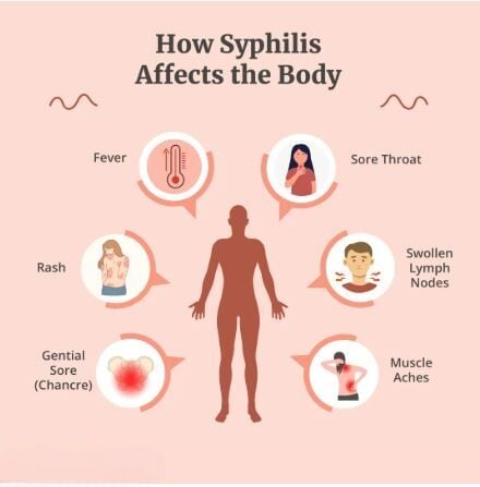 Syphilis surge grips Phuket as tourism booms again | News by Thaiger