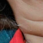 Fish bone pierces Thai woman’s throat and emerges through her neck | Thaiger