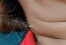 Fish bone pierces Thai woman’s throat and emerges through her neck