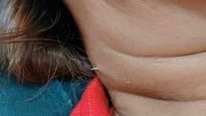 Fish bone pierces Thai woman’s throat and emerges through her neck