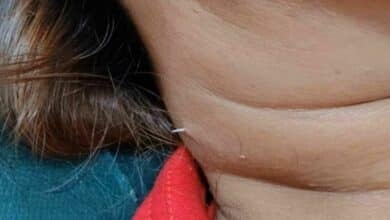 Fish bone pierces Thai woman’s throat and emerges through her neck