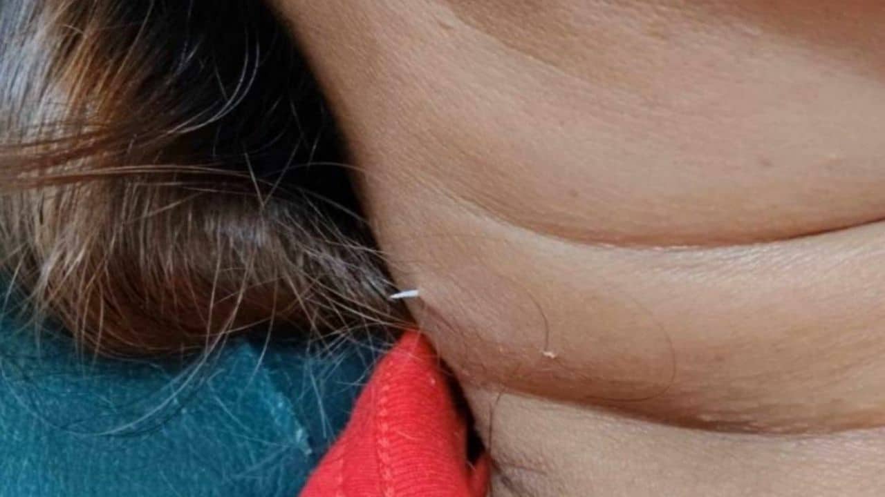 Fish bone pierces Thai woman’s throat and emerges through her neck