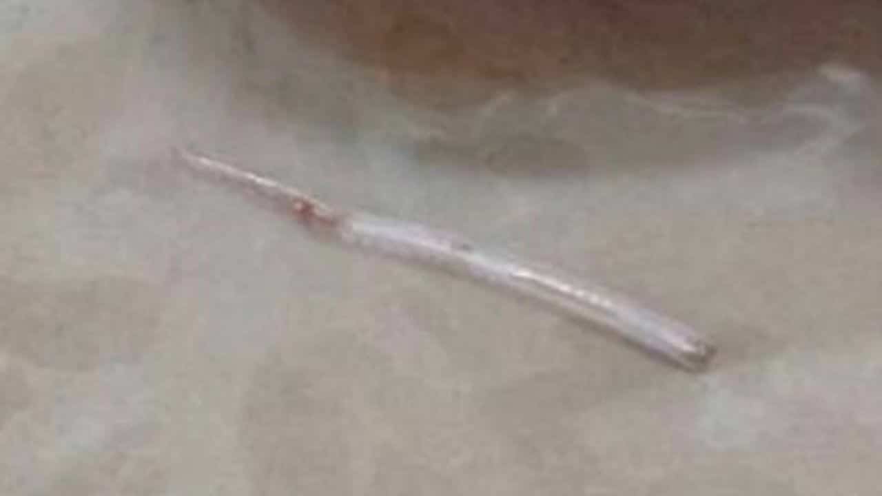 Fish bone pierces Thai woman’s throat and emerges through her neck | News by Thaiger
