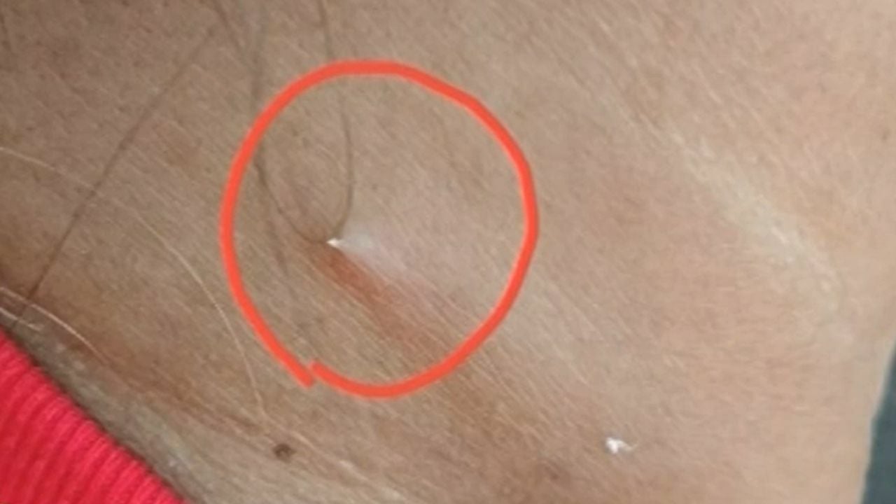 Thai woman injured by fish bone