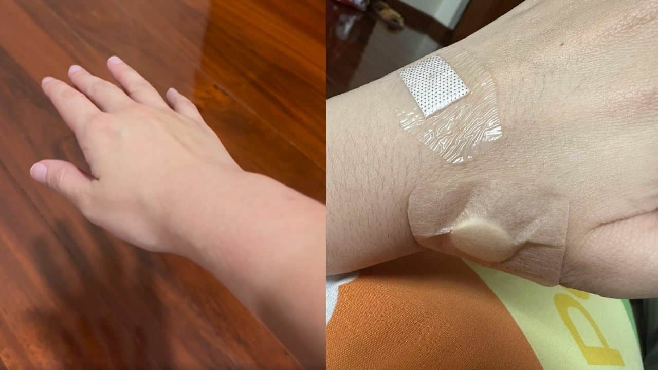Hand and arm injured due to mulfuntion ticket machine