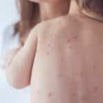 Measles surge in Thailand: Young children at high risk | Thaiger