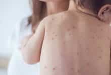 Measles surge in Thailand: Young children at high risk