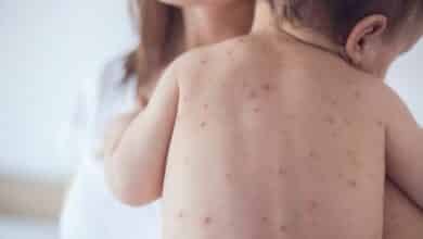 Measles surge in Thailand: Young children at high risk