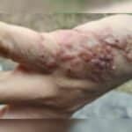 Thai man’s mysterious skin blisters revealed as &#8216;skin worms&#8217; | Thaiger