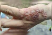 Thai man’s mysterious skin blisters revealed as ‘skin worms’
