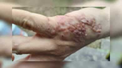 Thai man’s mysterious skin blisters revealed as ‘skin worms’