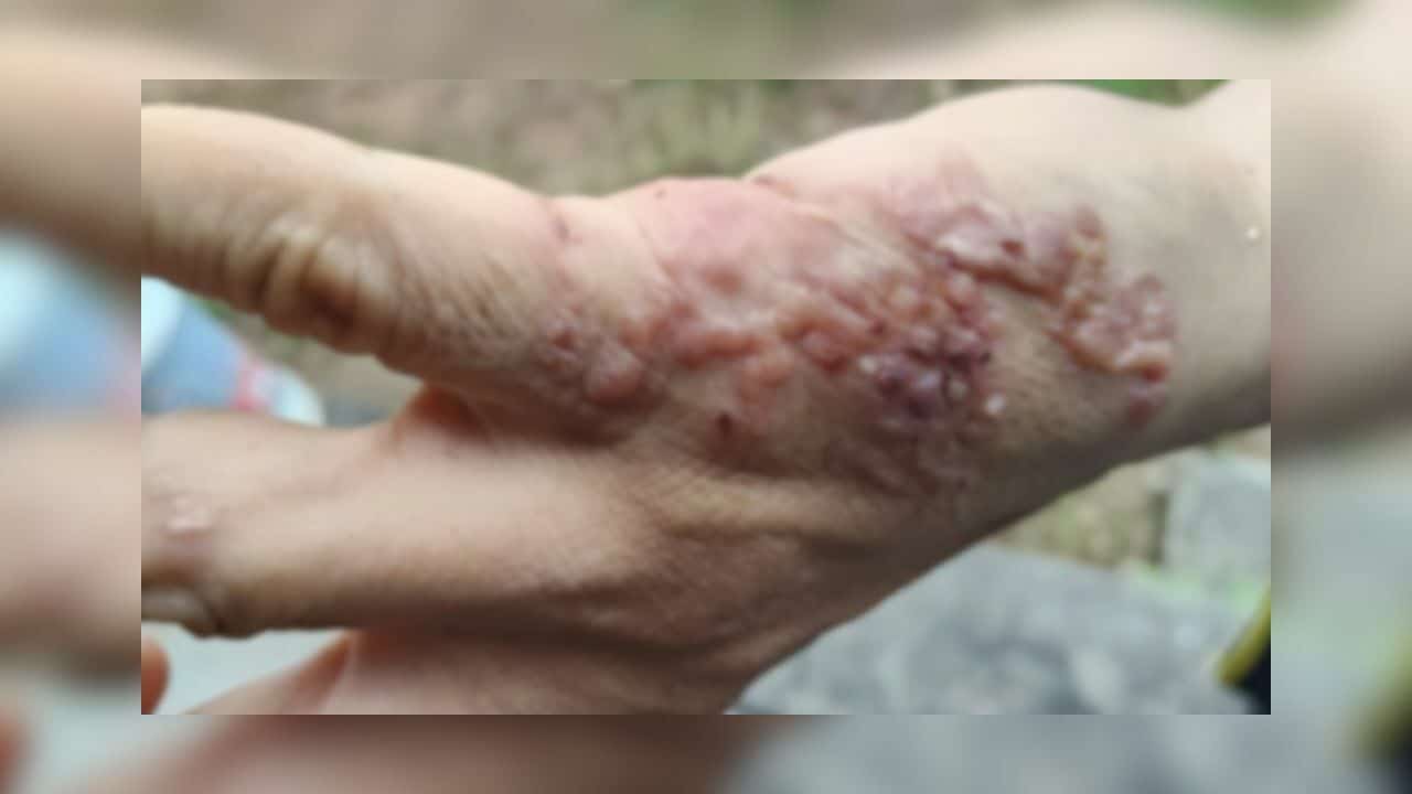 Thai man’s mysterious skin blisters revealed as ‘skin worms’