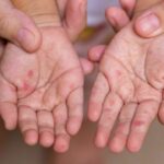 Hand, foot, and mouth disease outbreak hits young children | Thaiger