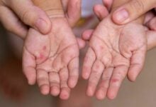 Hand, foot, and mouth disease outbreak hits young children
