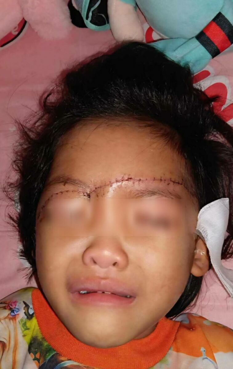 Ubon manhunt after machete attack leaves girl, 4, blind | News by Thaiger