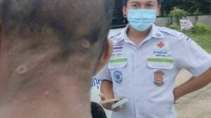 Chiang Rai man claims worms emerge from skin after forest visit