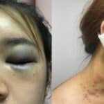 Thai transwoman brutally assaulted and raped by obsessed attacker | Thaiger