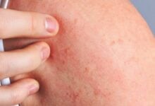 Skin scare: Thailand warns of itchy rash this rainy season