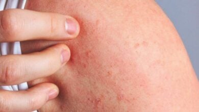 Skin scare: Thailand warns of itchy rash this rainy season