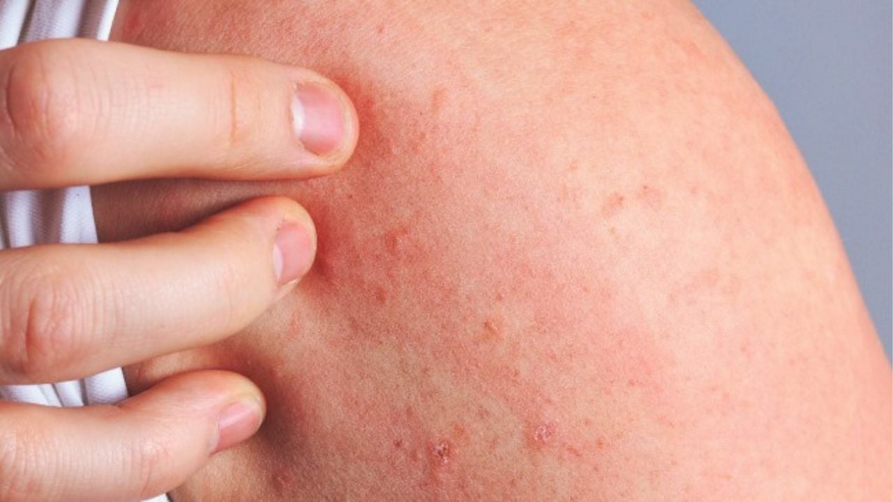 Skin scare: Thailand warns of itchy rash this rainy season