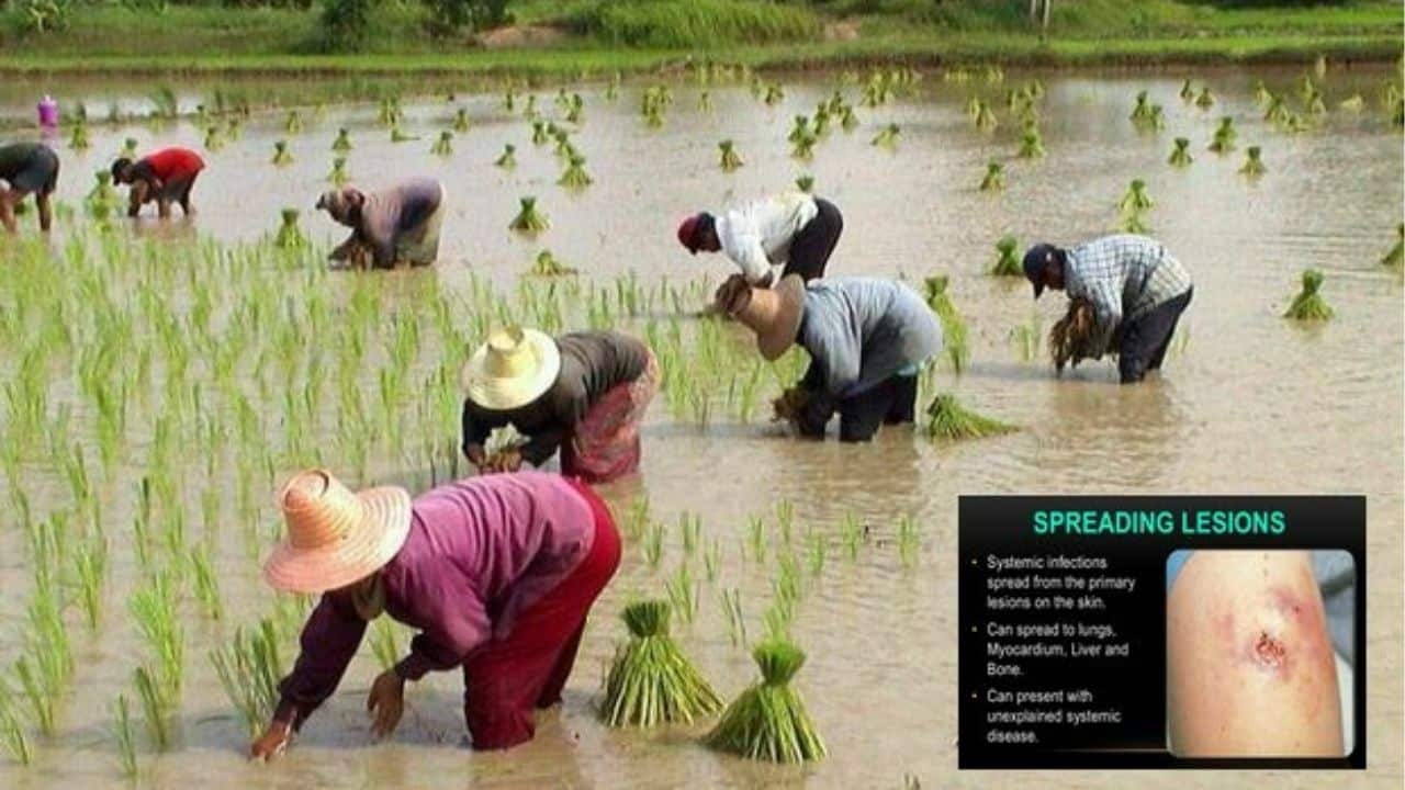 Melioidosis kills 72: Thai health ministry issues urgent warning