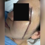 Thai woman suffers 54 stitches after brutal assault by ex-husband | Thaiger