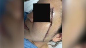 Thai woman suffers 54 stitches after brutal assault by ex-husband | Thaiger