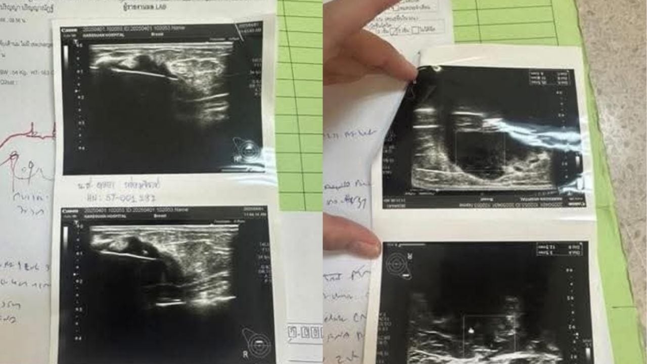 Thai woman suspected of faking cancer for money