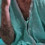Thai vendor nearly dies after shingles treated with folk remedy | Thaiger